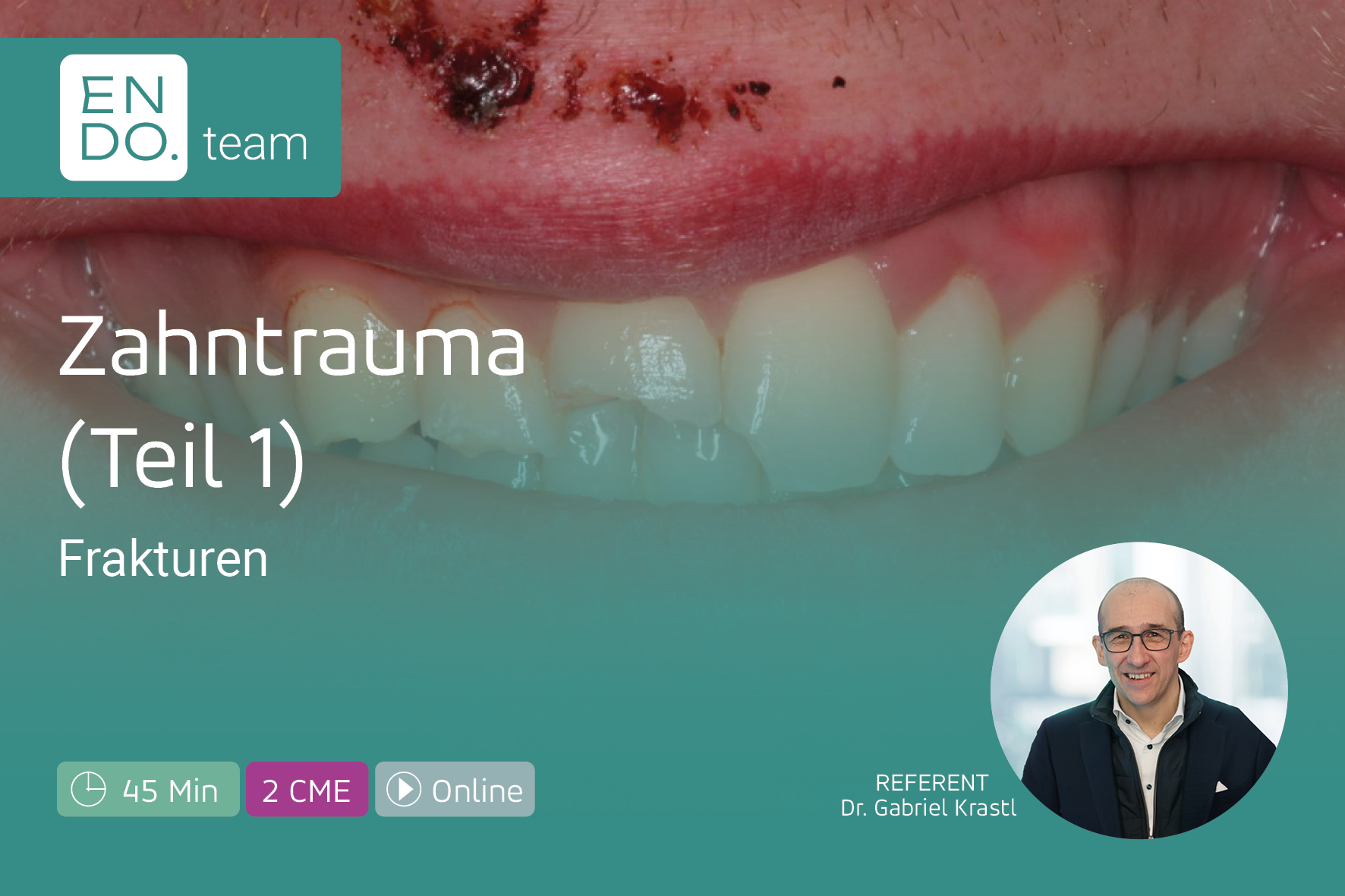 Zahntrauma Teil 1: Zahnfrakturen sicher versorgen und vital erhalten