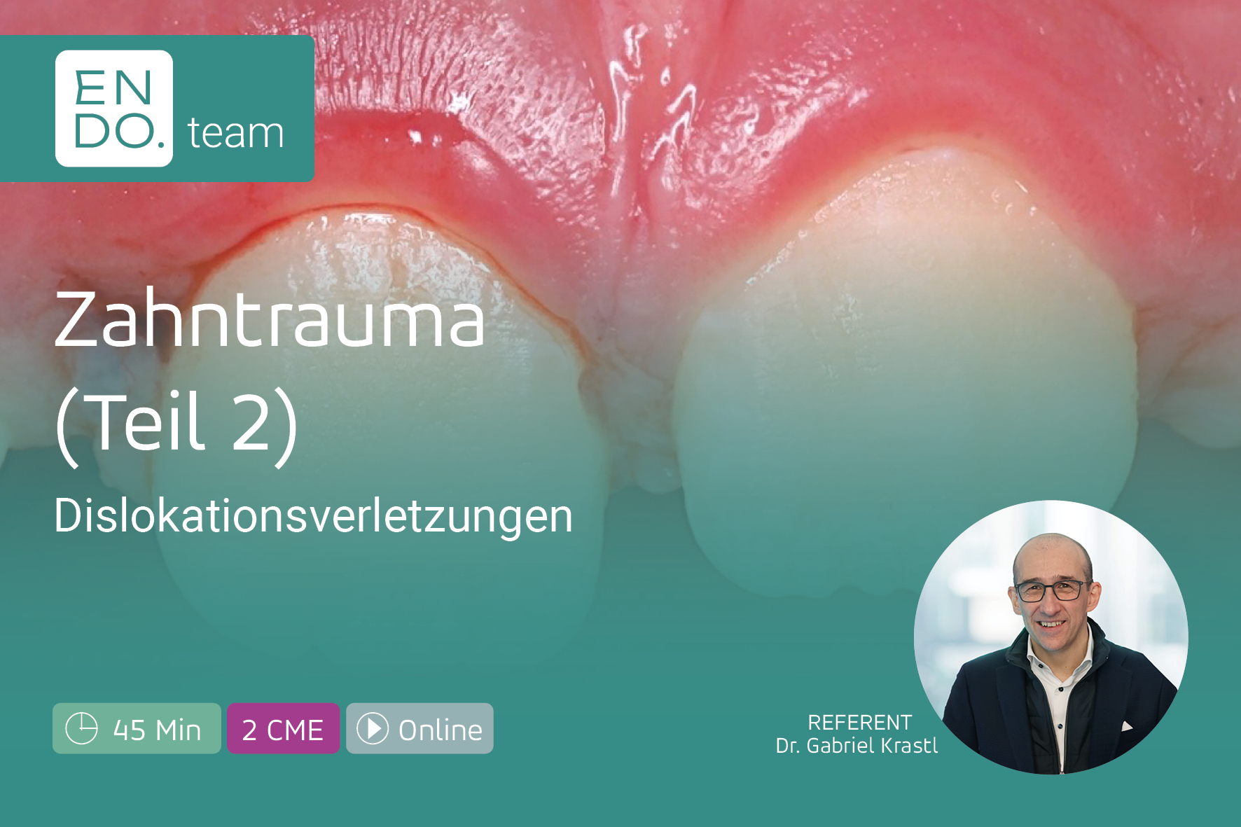 Zahntrauma (Teil 2): Dislokationsverletzungen sicher behandeln